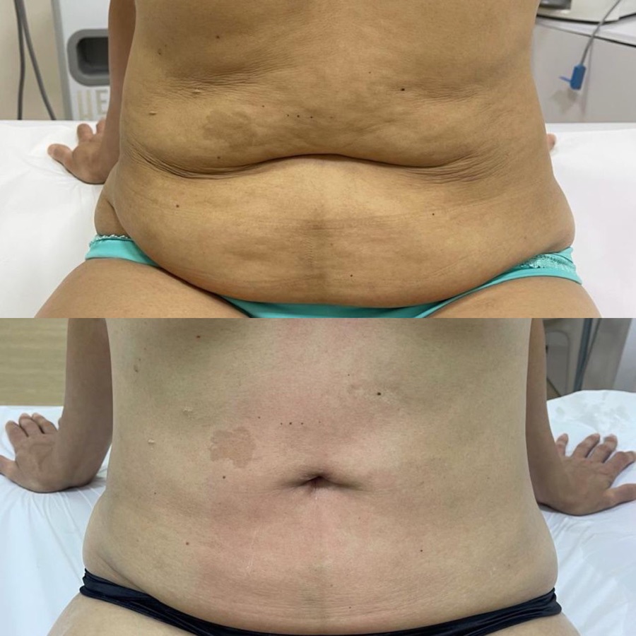 Resultado real — Antes e Depois · Clínica Priscila Nardy