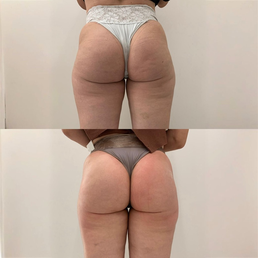 Resultado Tratamento Corporal — Antes e Depois