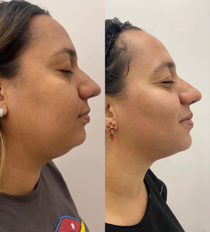 Resultado Harmonização Facial — Antes e Depois